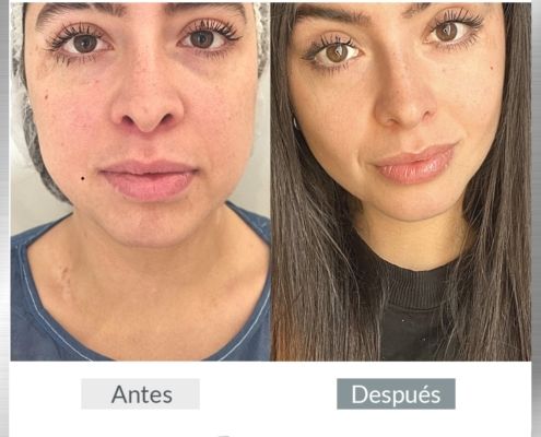 bichectomia barcelona antes y despues